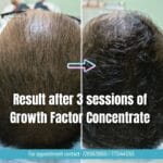 PRP Hair Treatment