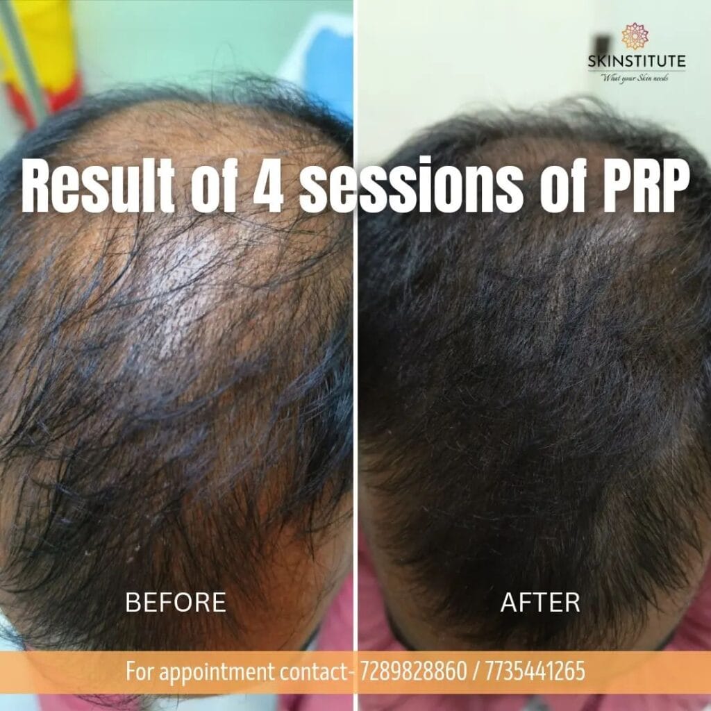 PRP Hair Treatment