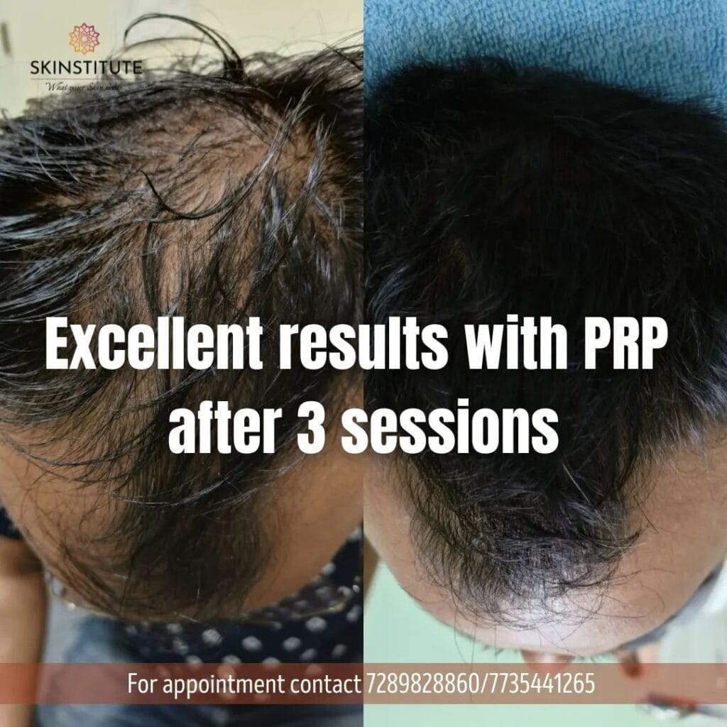 PRP Hair Treatment