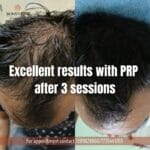 PRP Hair Treatment
