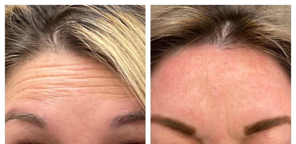 "Before and after image showing the significant reduction of lines on a person's forehead after receiving anti-aging treatment, highlighting smoother and more youthful skin."