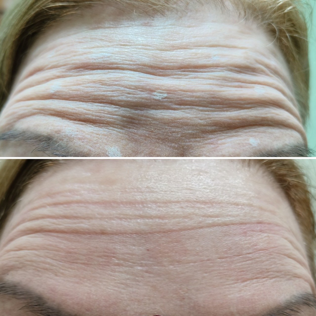 "Transformative Results: Forehead Lines Reduction"