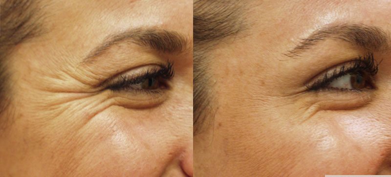 "Close-up of a patient’s radiant skin after receiving skin booster and Botox treatments."