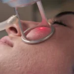 CO2 Laser Treatment in Bhubaneswar