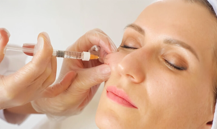 Dermal Fillers Treatment in Bhubaneswar