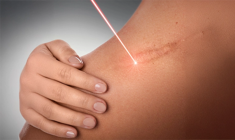 Keloid Treatment in Bhubaneswar