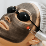 Laser Carbon Peel Treatment in Bhubaneswar