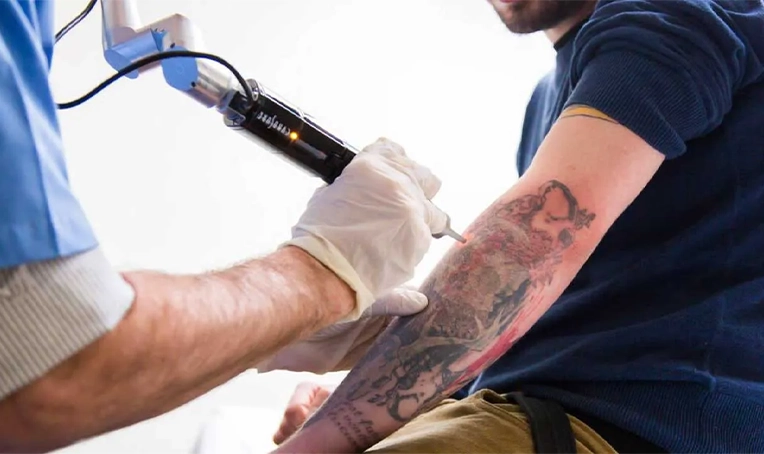 Laser Tattoo Removal Treatment in Bhubaneswar