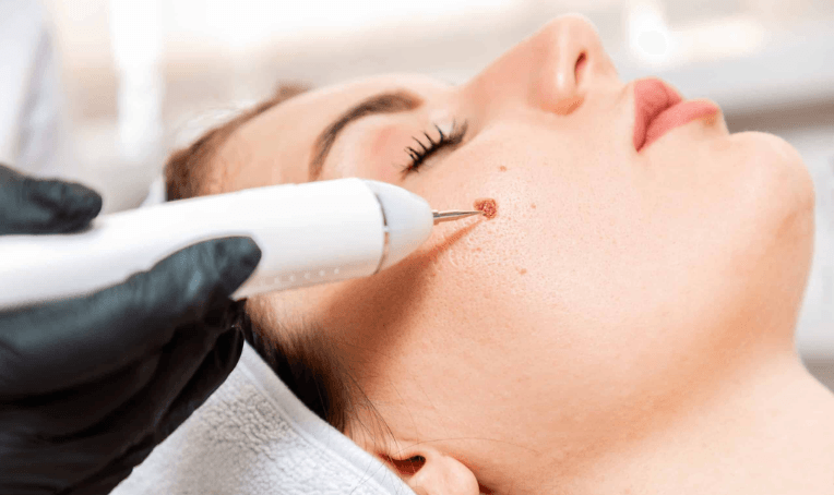 Mole Surgery Treatment in Bhubaneswar
