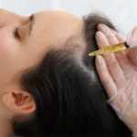 Platelet Rich Plasma (PRP) in Hair Treatment in Bhubaneswar