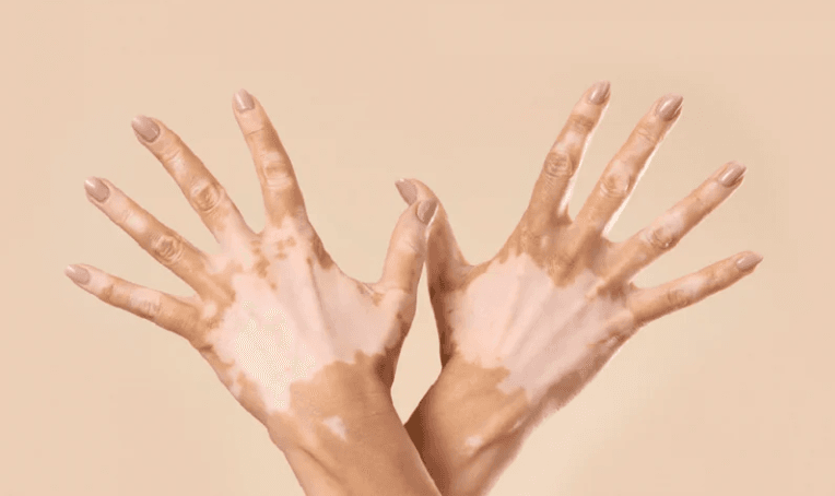 Vitiligo Surgery Treatment in Bhubaneswar