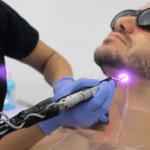 Laser Beard Shaping Treatment in Bhubaneswar