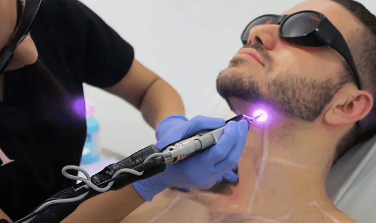 Laser Beard Shaping Treatment in Bhubaneswar