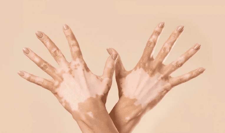 Vitiligo condition on hands