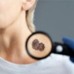 How Dermoscopy Helps Diagnose Skin Cancer: A Clearer Look Beneath the Skin