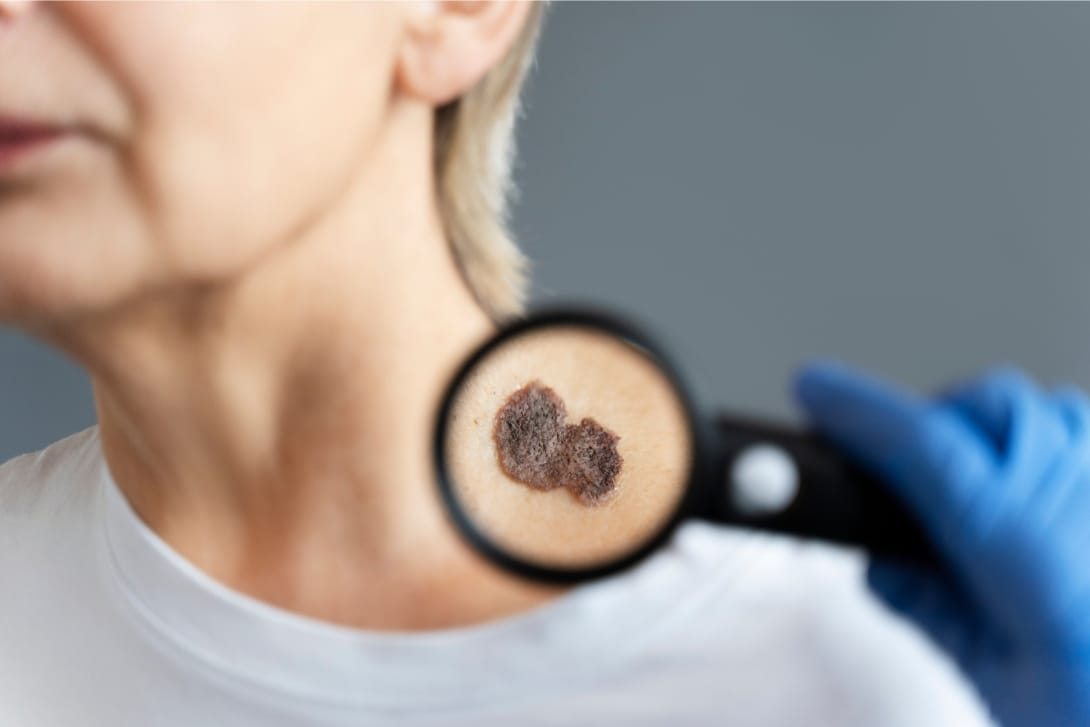 Dermoscopy Treatment
