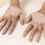 Best Vitiligo Surgery in Bhubaneswar for Lasting Results