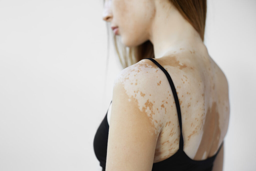 Woman’s shoulder and upper back showing vitiligo patches.