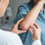 Venereology Treatment