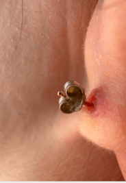 Ear Piercing Keloids​