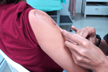 Keloid Treatment​
