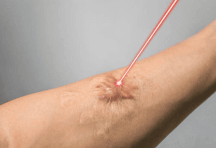 Laser Keloid Treatment​