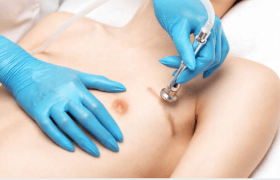 Post-Surgical Scars​