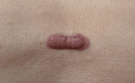 Recurrent Keloids​