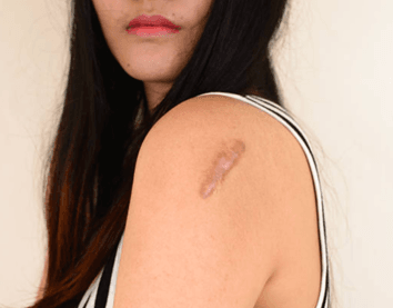 Scar Rejuvenation​