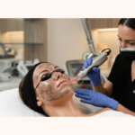 Carbon Peeling Treatment: Benefits, Procedure & Who Should Consider It in 2026